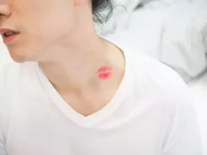 7 Things you must know about hickeys aka love bites