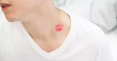7 Things you must know about hickeys aka love bites